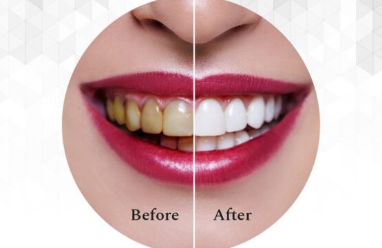 activated charcoal teeth whitening powder